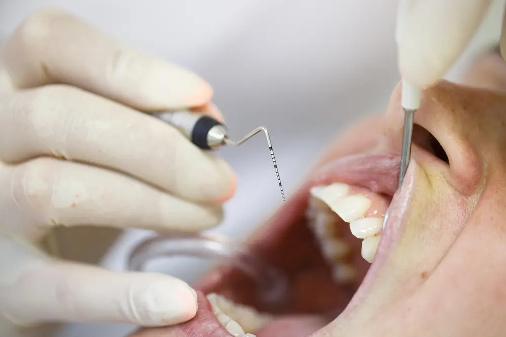 Dental hygienist measuring tooth pocket depth with periodontal probe